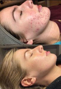 niamh carroll adult acne transformation