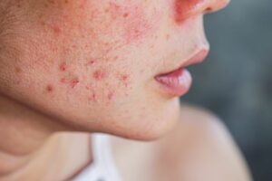 woman with adult acne on side of face