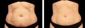 Emsculpt neo stubborn belly fat reduction DrMediSpa