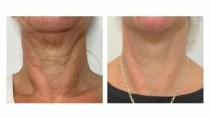 Saggy skin This non surgical facelift can take years off your faceMAIN (2)